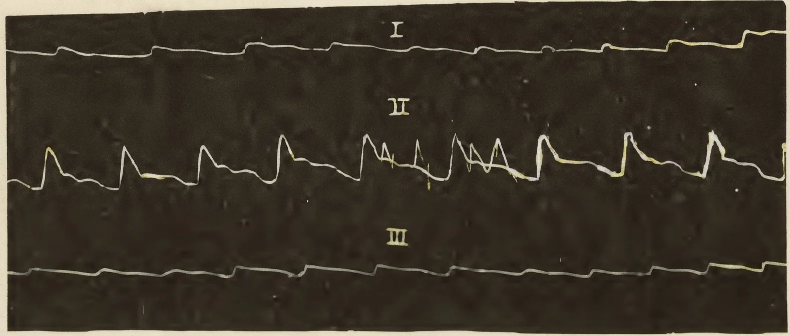 HEART PULSATIONS AS SHOWN BY SPHYGMOGRAPH