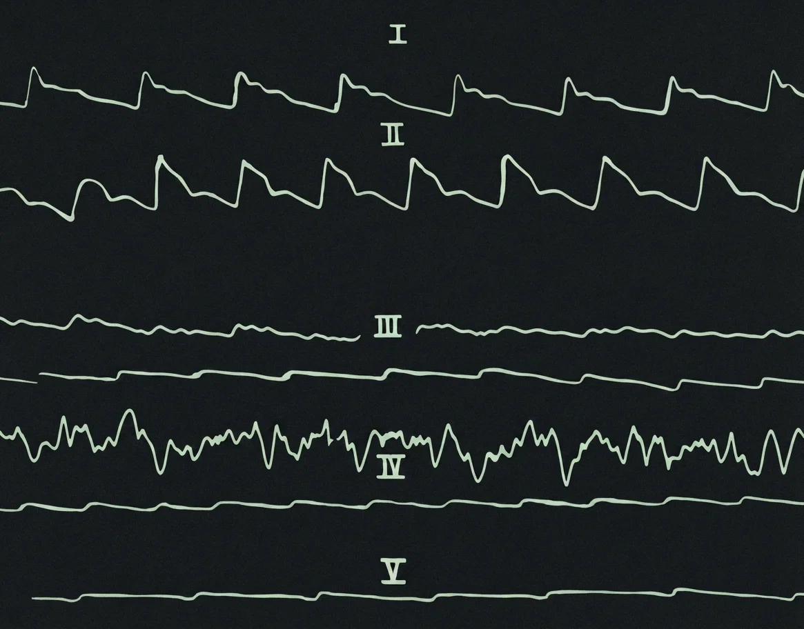 Plate C.—Heart tracings I and II, strong man of 36 years, weight 230, No. I before smoking, No. II after. No. III, low vitality of nervous fatigue. No. IV, young woman on the verge of nervous prostration. No. V, of a long tobacco user.