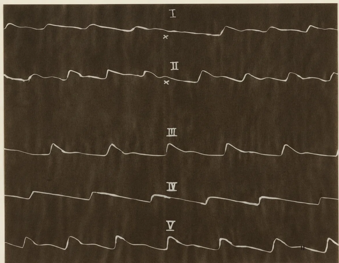Plate B.—Nos. I and II, heart tracings of a young man of 18, tobacco user two years. Note skip of heart at x. No. III, strong, healthy youth. No. IV, a cool, calculating person. No. V, heart tracings of a strong, healthy young woman.